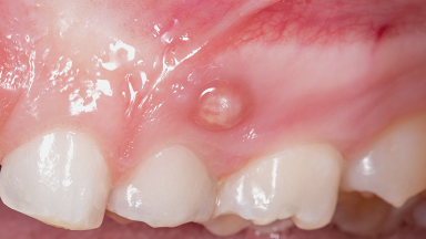 Endodontic Infection