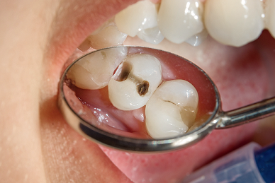 tooth cavity image