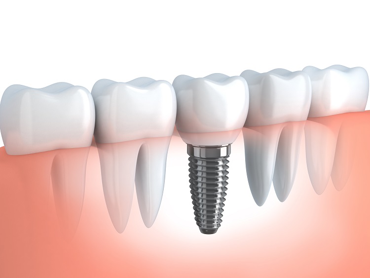 Implant Crown Image