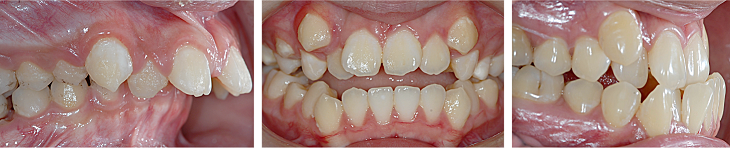 Orthodontic services at Neua Dental