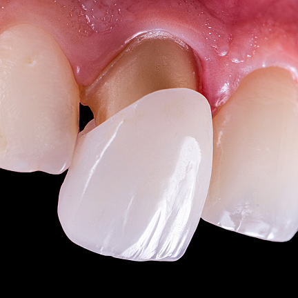 Porcelain Crowns at Neua Dental