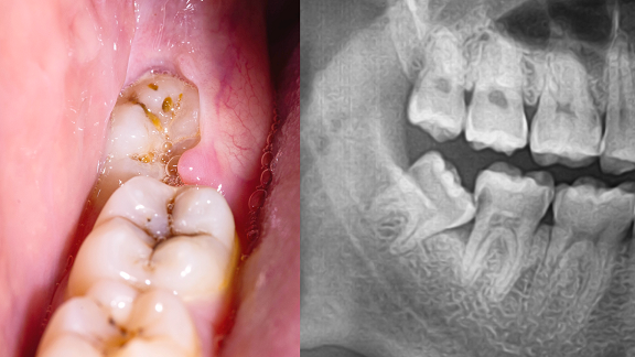 Wisdom molar impaction.png