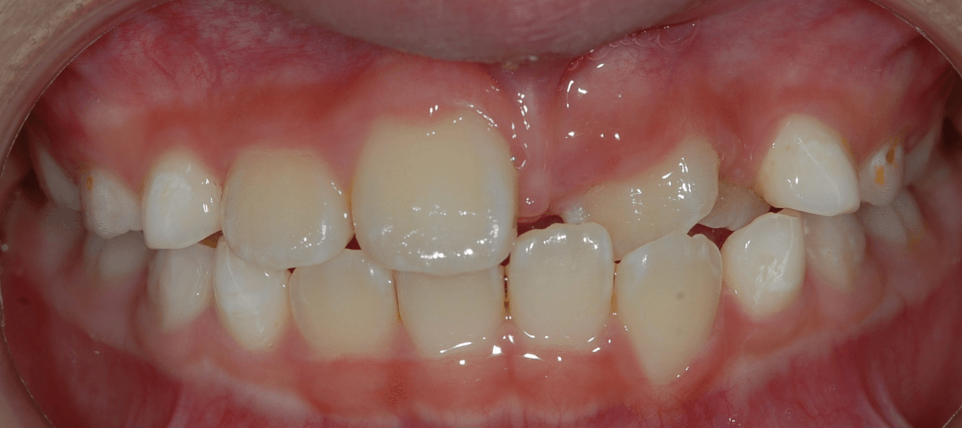 crossbite crooked teeth malocclusion